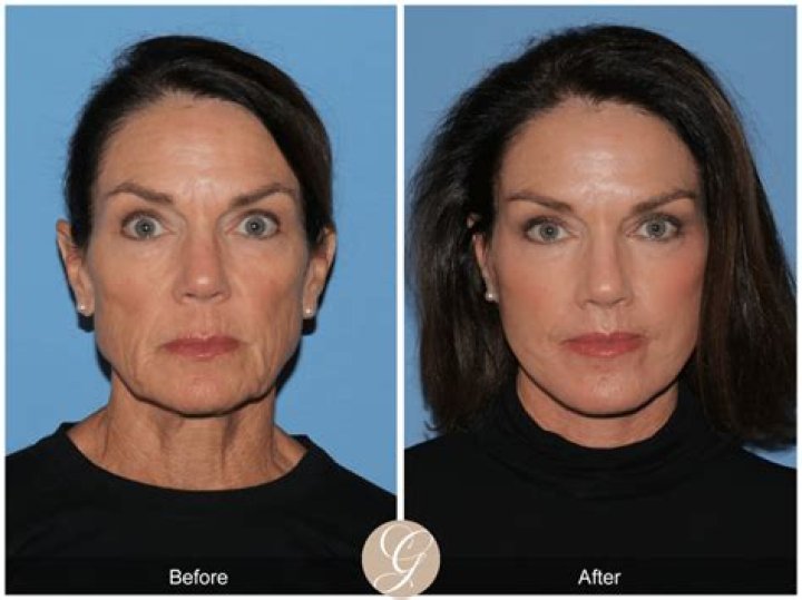 Emily Simpson's Facelift Journey Revealed