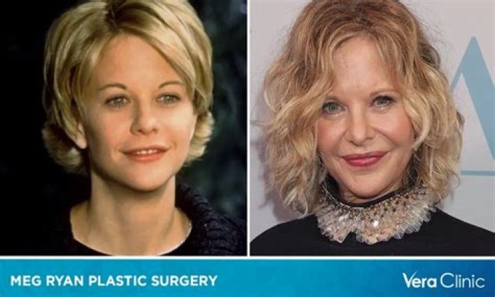 Meg Ryan's Transformation: Plastic Surgery Revelations